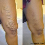 Varicose Veins - Courtesy of VenaCure