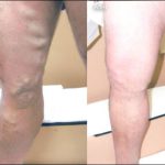 Varicose Veins - Courtesy of VenaCure